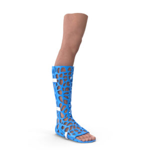Blue 3D printed cast on foot.